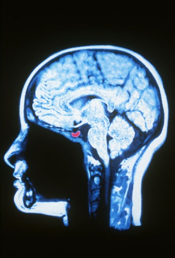 5 Reasons Cortisol is Ruining Your Sleep
